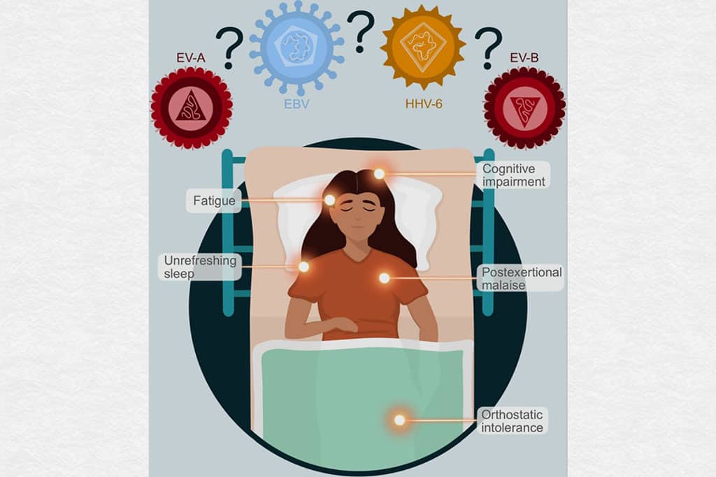 Chronic Fatigue Syndrome
