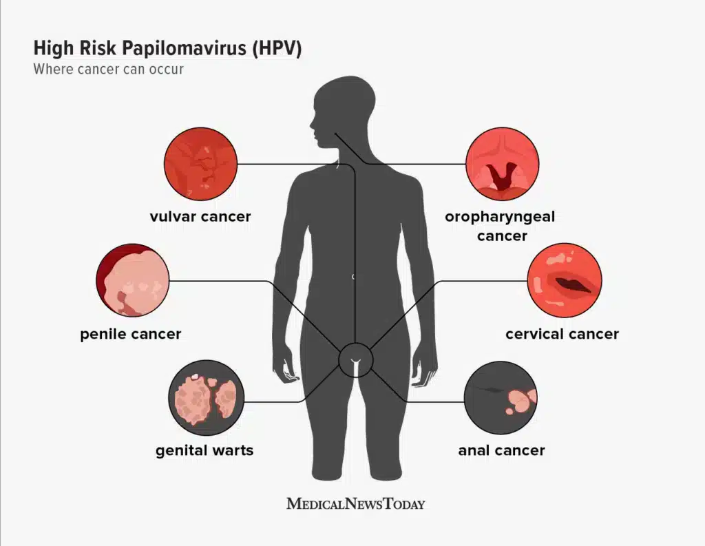 hpv-symptoms-1296x1000-body-1024x793