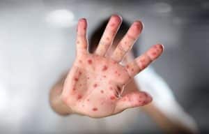 measles-2-300x192