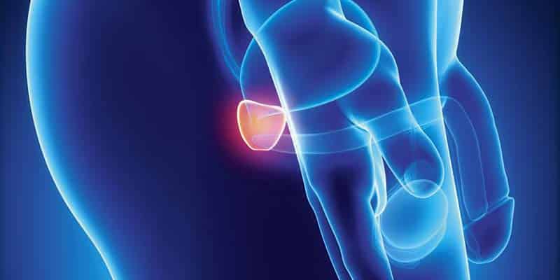 brachytherapy in the treatment of prostate cancer
