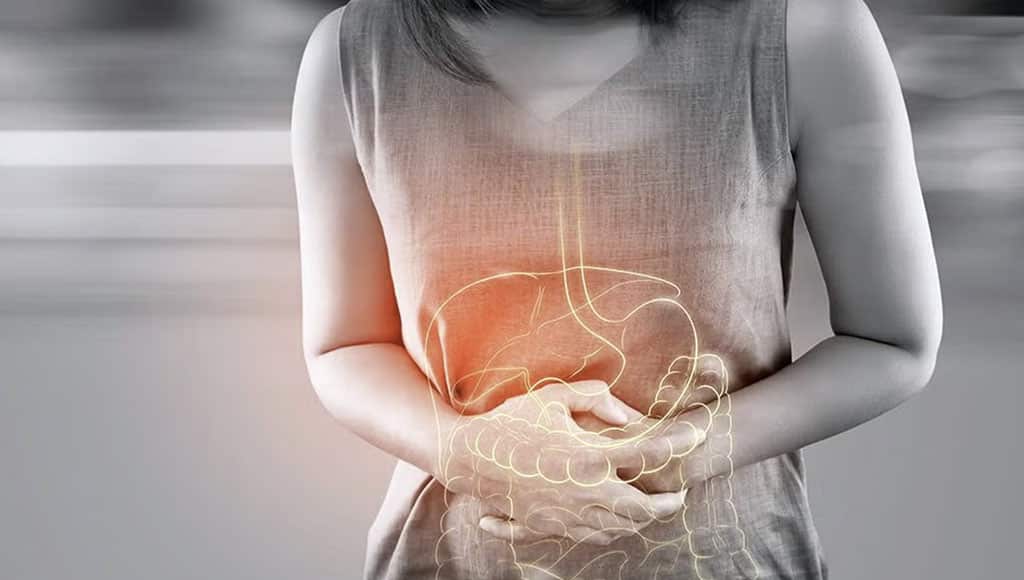 Ulcerative Colitis