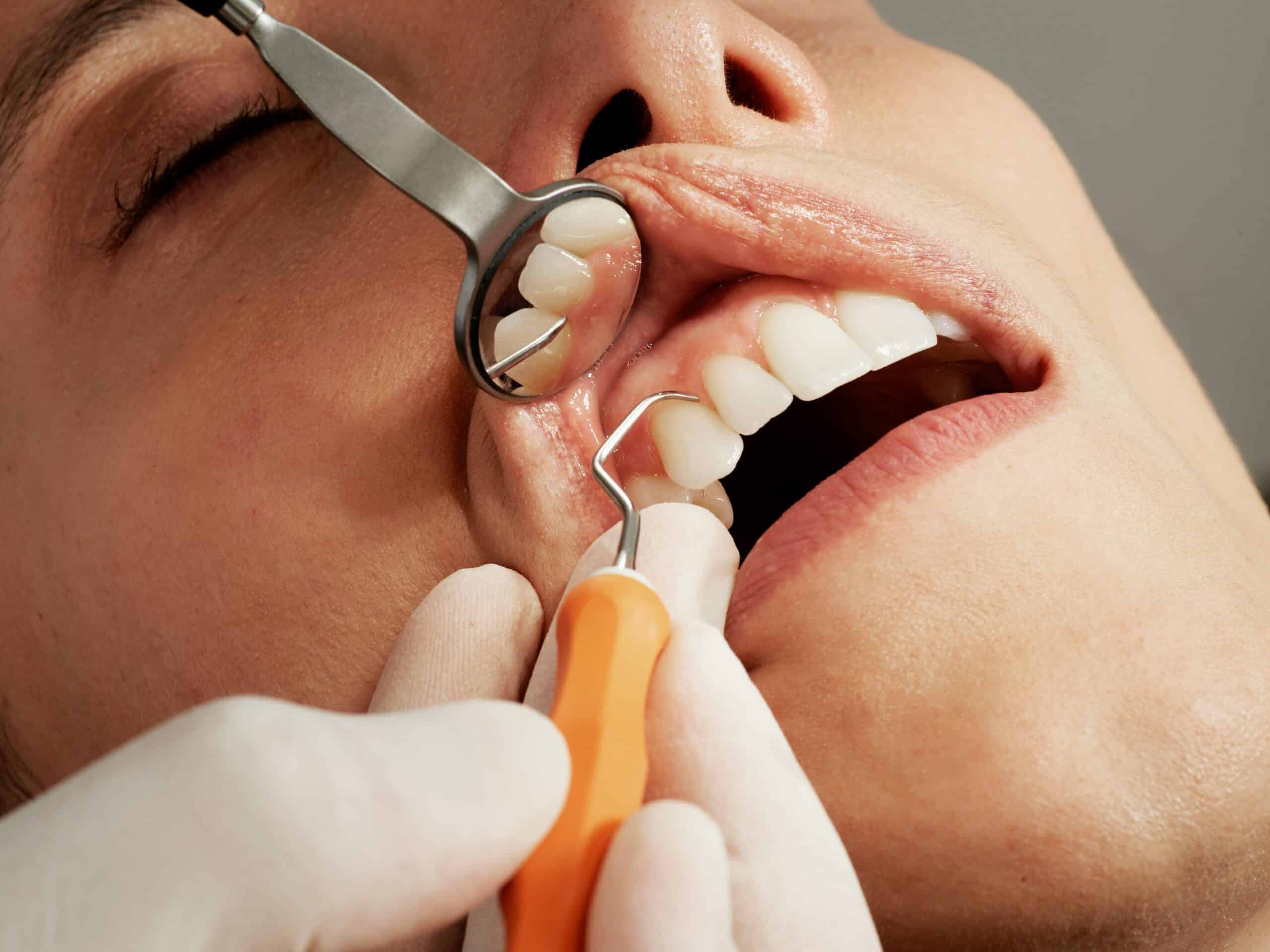 Six in 10 Portuguese missing teeth – survey