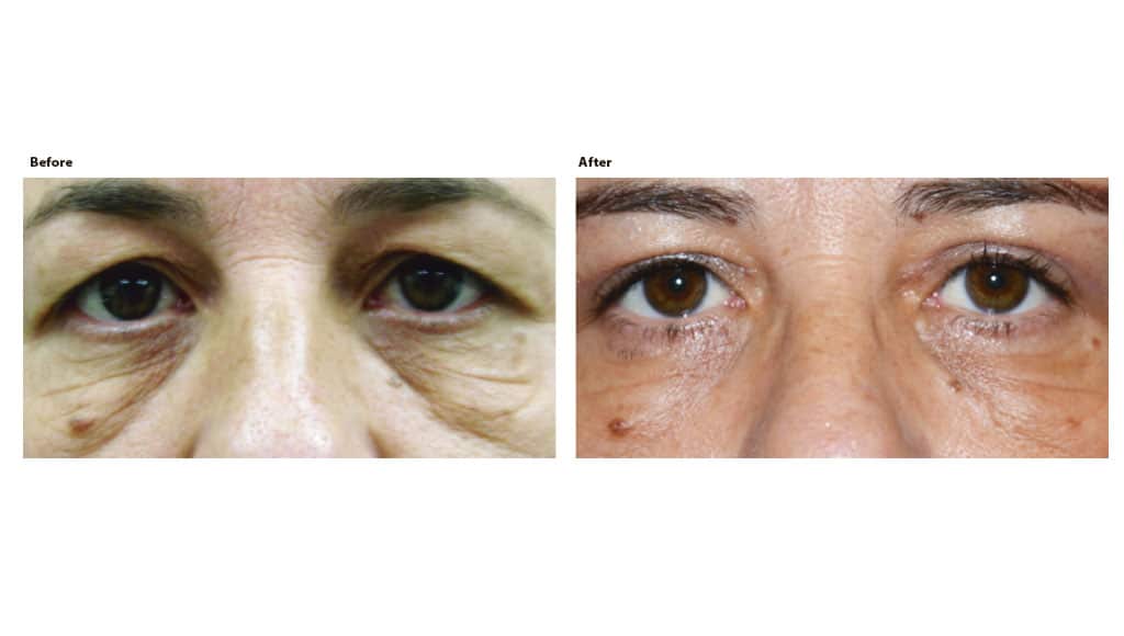 Surgery procedure by Dr Fabiola Murta, Consultant Oculoplastic Surgeon