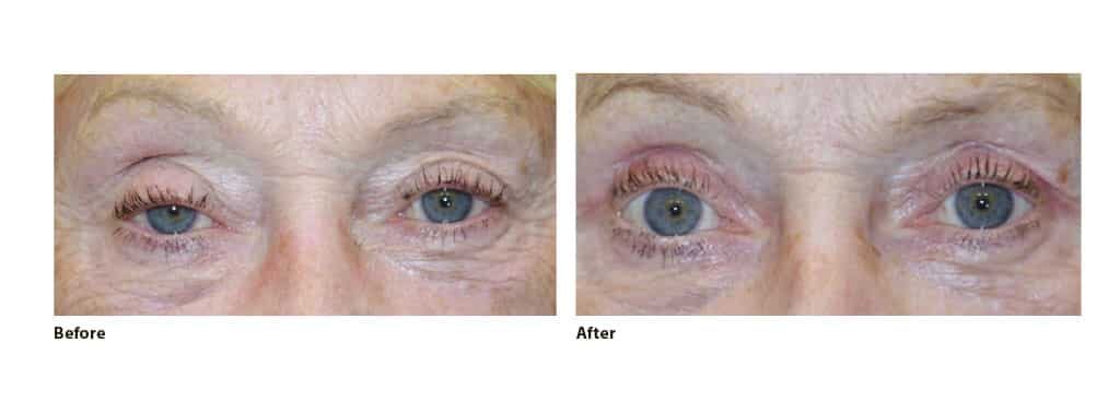 Surgery procedure by Dr Fabiola Murta, Consultant Oculoplastic Surgeon